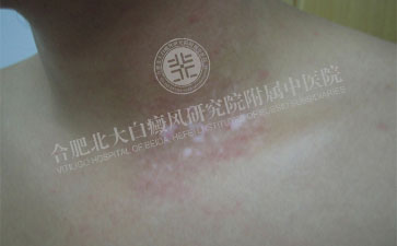 年轻人脖子上为什么会受到白癜风的困扰 
