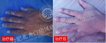 【第221面锦旗】私人定制祛白方案,三十余年顽