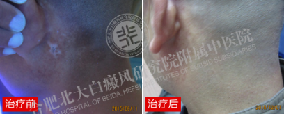 【第221面锦旗】私人定制祛白方案,三十余年顽