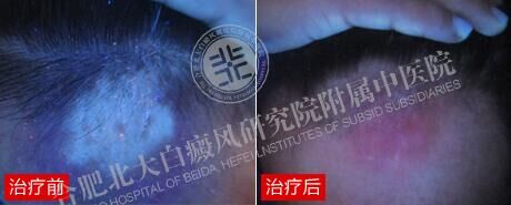 【第222面锦旗】12周告别白癜风 21岁大学生自信迎