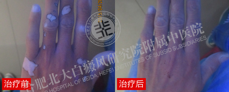 【第223面锦旗】90后父亲告别白斑重新撑起一个家