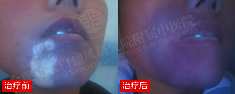 【第225面】花季突遭白癜风,祛白谱写华丽变脸