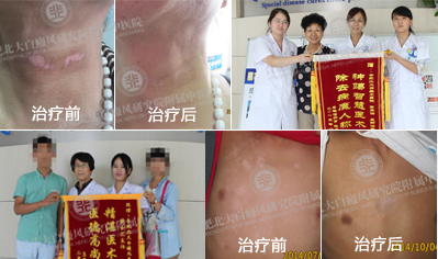 热烈庆祝美国308nm祛白诊疗系统落户我院一周年