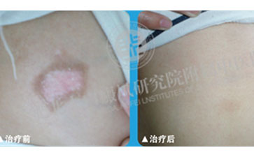腹部白癜风治疗方法 