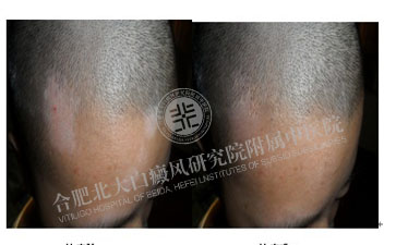 儿童白癜风的发病率为什么那么高 