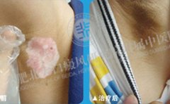 白癜风确诊病因的常见方法有哪些 