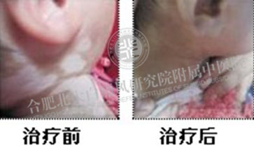 脖子有白癜风要注意什么呢 