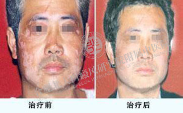  白癜风的白斑判断的方法是什么呢  