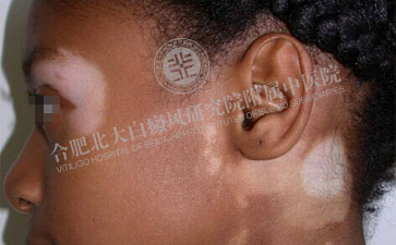  嘴唇白癜风病能用口红吗  