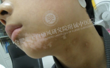  白斑的颜色可以诊断病情严重程度么  
