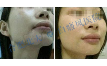  女性泛发性白癜风的护理方法是什么呢  