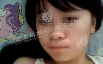 女性白癜风都会哪些严重的症状呢 