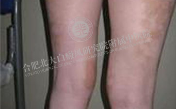 腿部白癜风患者怎么护理啊 